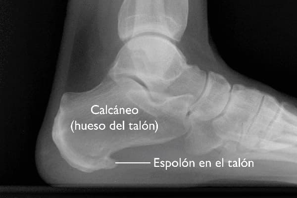 Espolones calcáneos