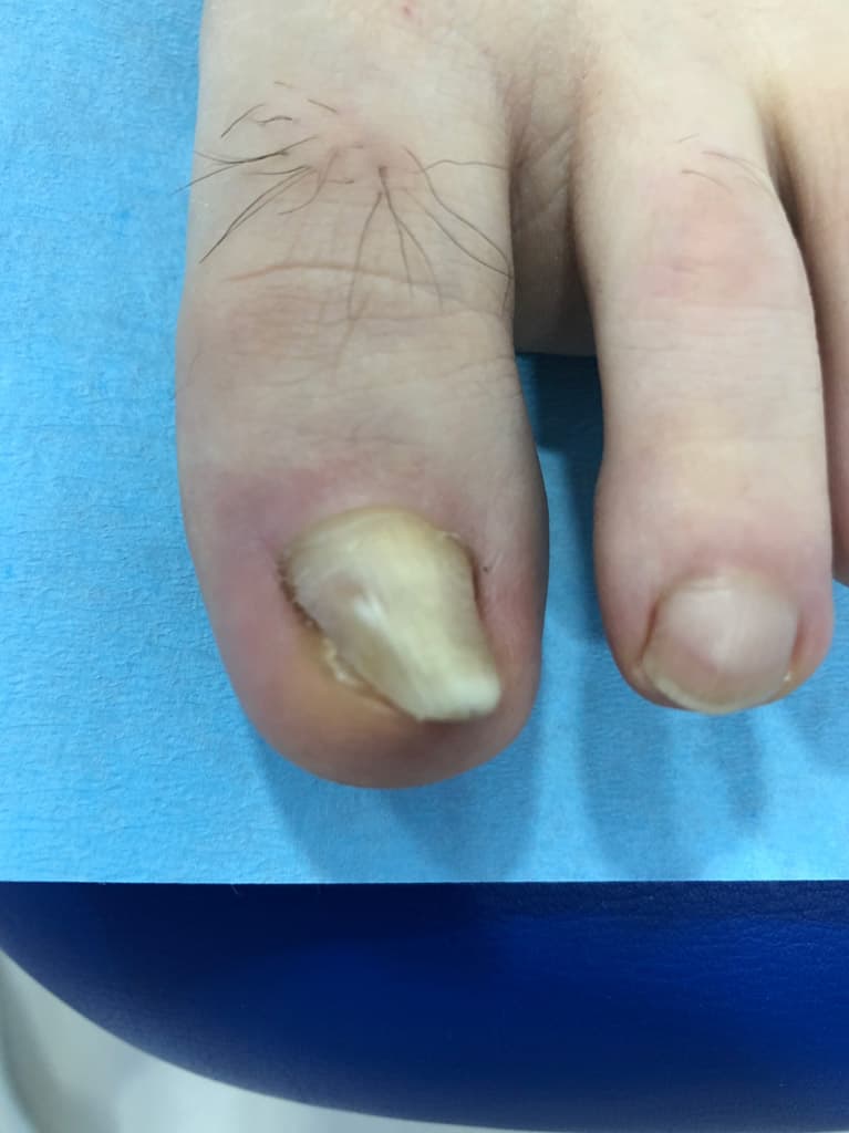Exostosis